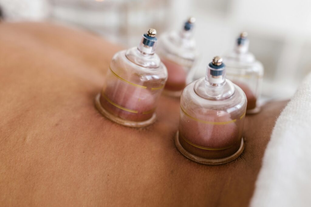 Dry Cupping Therapy Up-Close Detailed image of cupping therapy on a person's back, showcasing alternative medicine practice.
