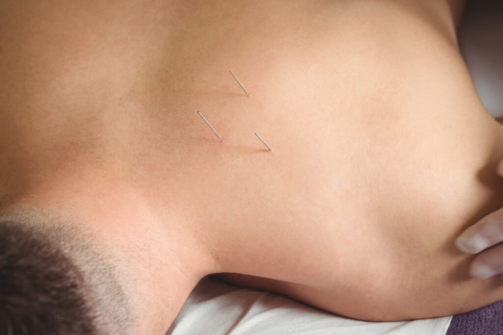 Acupuncture for men's health austin