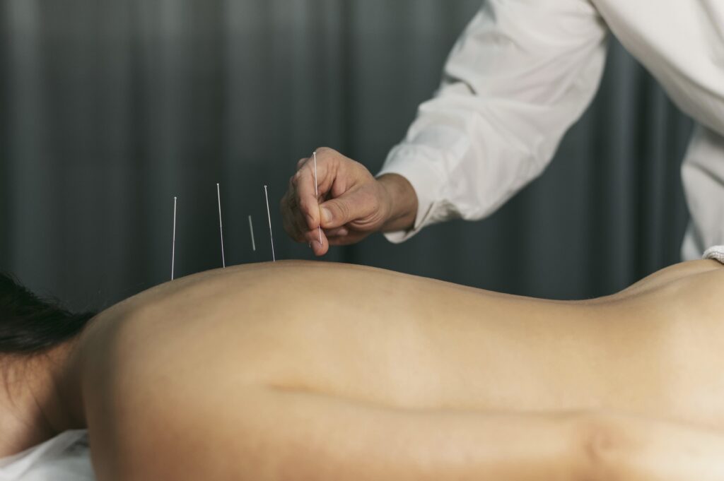 Acupuncture treatment at Austin Transformational Health for metabolic health and GLP-1 alternatives